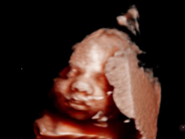 ecografia 31 semanas de embarazo