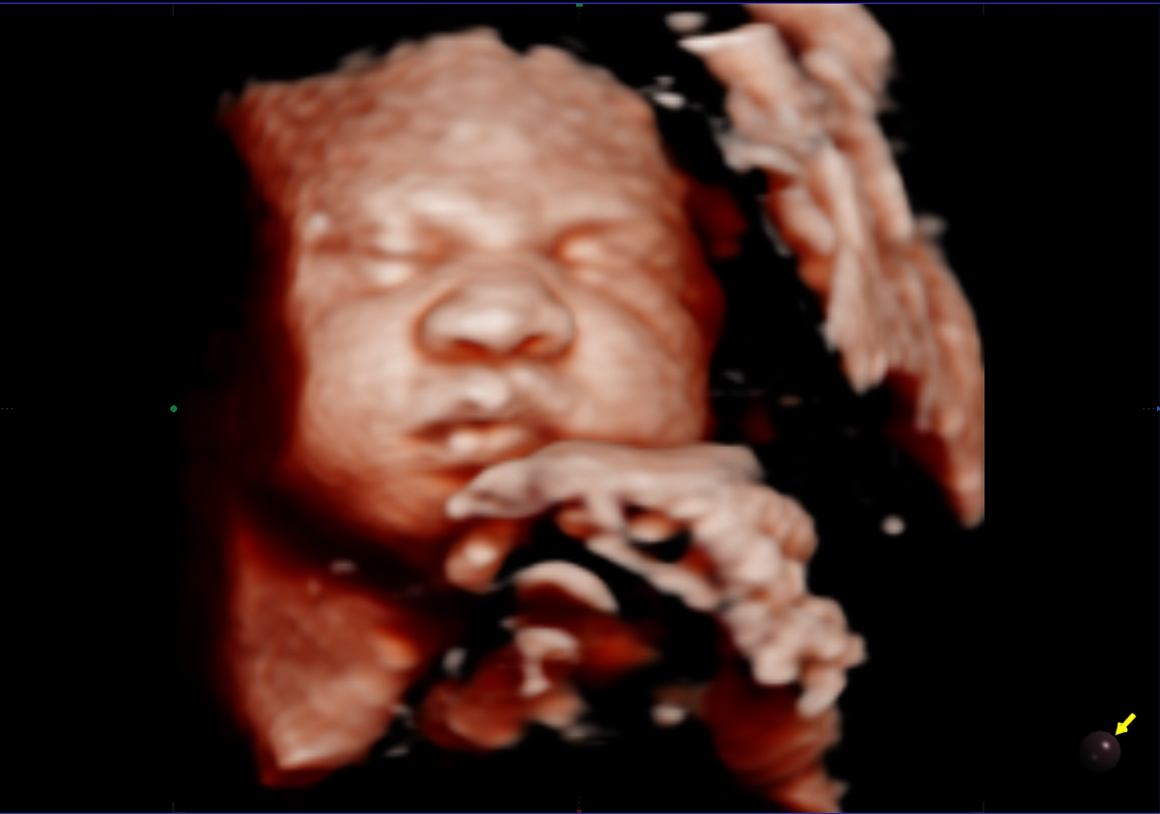 Ecografía Semana 33 de Embarazo | WelcomeBaby5D